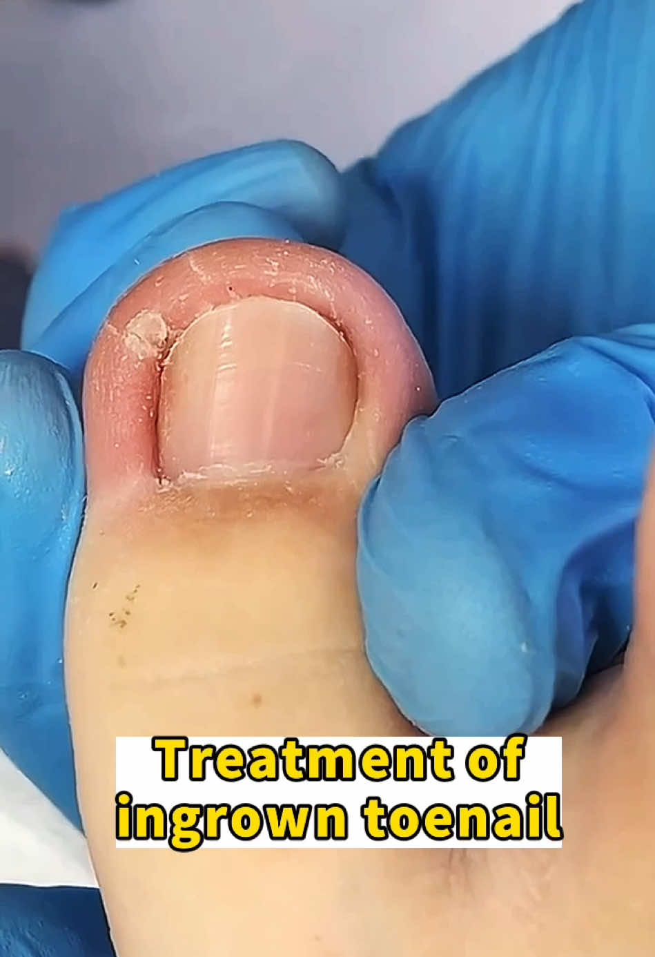 #ingrowntoenailremoval #tiktokchallenge #foryou #viralvideo #thisis4u #ingrowntoenail #nails #toenails #pedicure