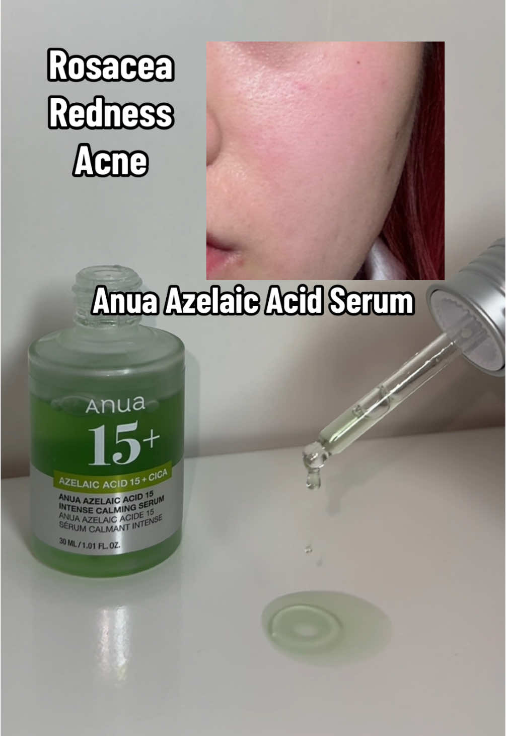 Anua Azelaic Acid💚✨ @Anua Store US   #anua #AnuaNewArrivals #anuaazelaicacidserum #azelaicacid #azelaicacidserum #redness #acne #sensitiveskin #kbeauty #glassskin #glassskinroutine #koreanskincare #koreanskincareproducts #koreanskincareroutine #koreanserum #rosacea #irritatedskin 