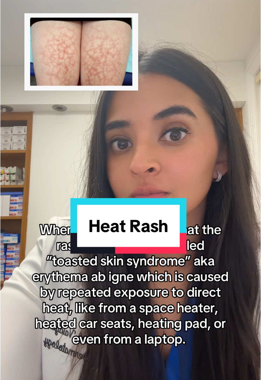 this is a common rash in dermatology that is directly related to heat exposure 🔥 #skincare #skincaretips #skincareproducts #SkinCare101 #dermatologist #dermatology #rash #LearnOnTikTok 