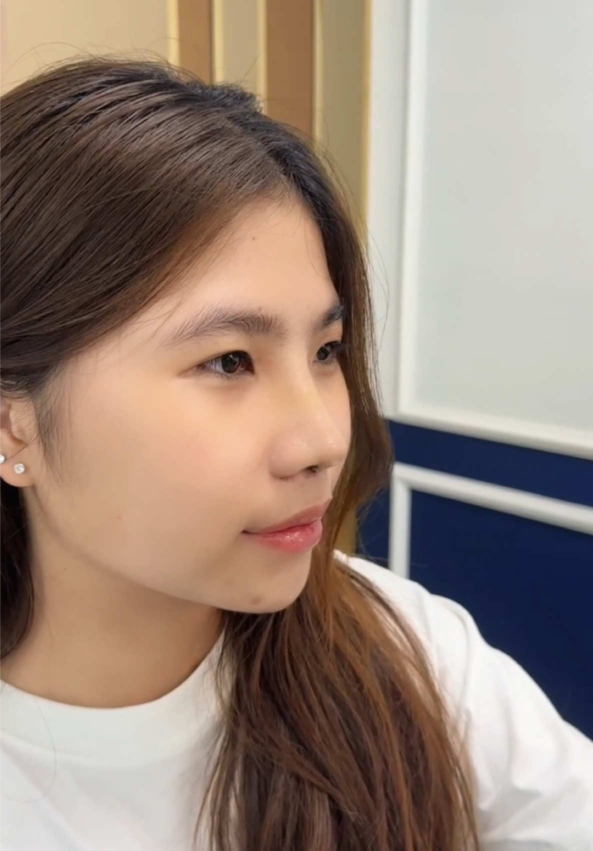 Em gái đến từ Đắc Lắc rất dễ thương #drson #operasi #hidung #nose #Indonesia #Thailand #malaysia #angkathidung #rhinoplastistruktur #xuhuong 