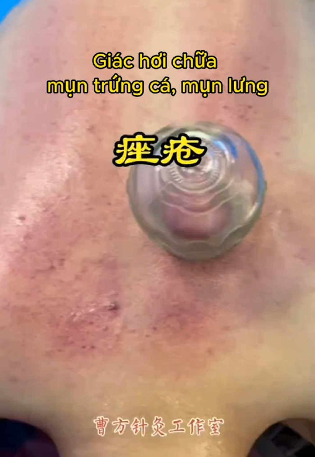 Giác hơi chữa mụn trứng cá, mụn lưng #yhoccotruyen #xoabopbamhuyet #yhcttrunghoa #giachoi #muntrungca 