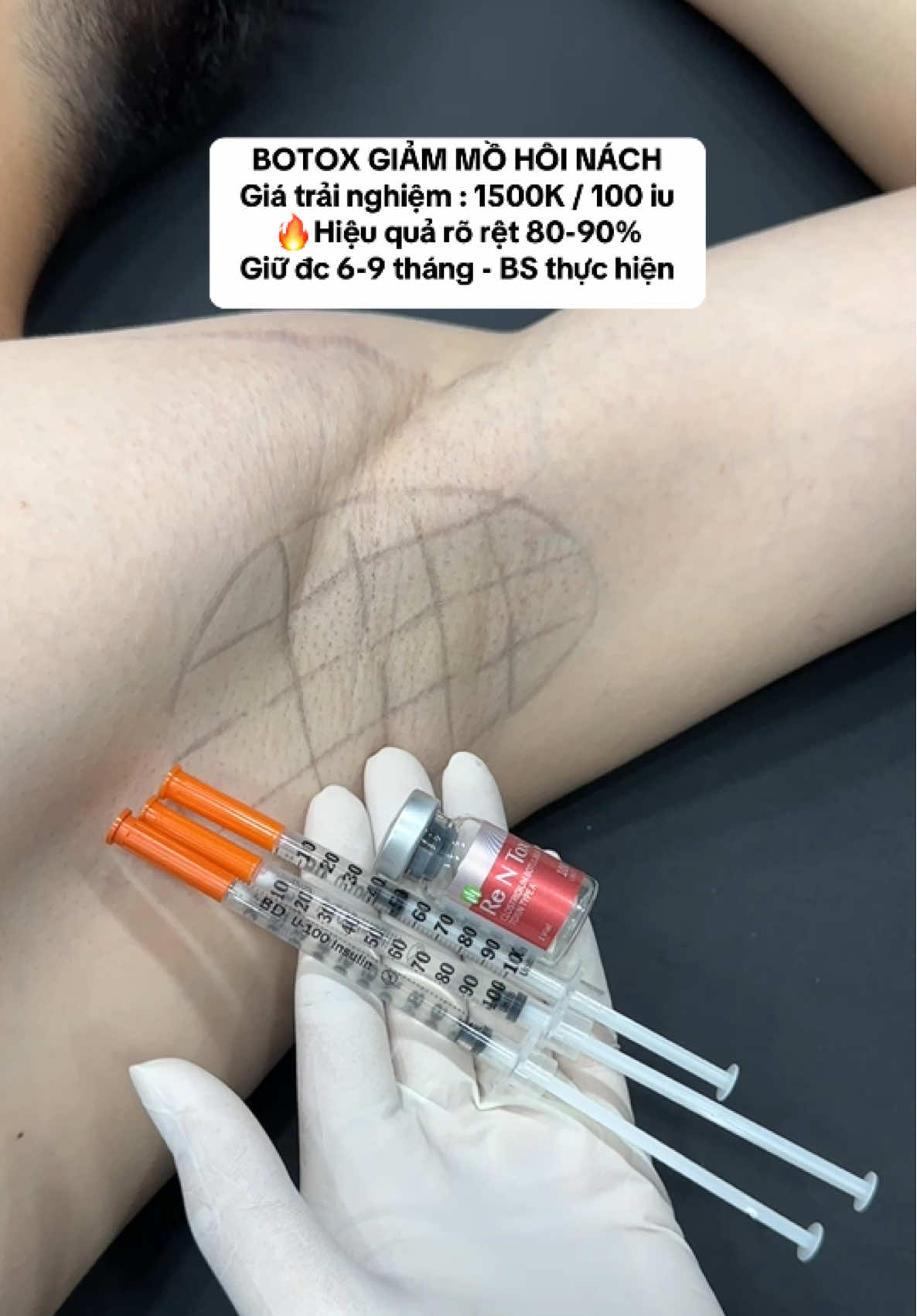 BOTOX MỒ HÔI NÁCH  ➤➤➤ Giảm đến 70% mồ hôi với thời tiết nắng nóng như vậy ✅HIỆU QUẢ LIỆU TRÌNH -  Giảm tiết mồ hôi - Cải thiện tình trạng mùi cơ thể - Cải thiện tình trạng tay chân đổ mồ hôi  - Hiệu quả sẽ kéo dài từ 6 -8 tháng từ theo cơ địa của mỗi người ✅ỨNG DỤNG PHÙ HỢP VỚI ✓ Người đổ mồ hôi nhiều ở nách ✓ Người gặp rắc rối với mồ hôi tay chân ✓ Người gặp vấn đề về mùi cơ thể#phongkhamdalieuqclinic #pkckdalieuqclinic #botox #botoxmohoinach 