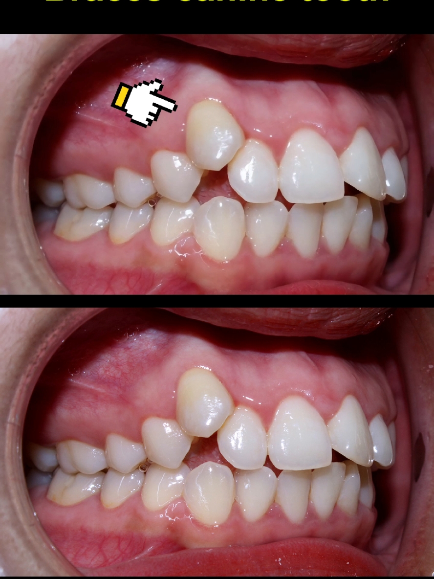 Braces evolution, crooked teeth. 28 months duration #braces #brackets #dentist #orthodontist #teeth #dentistry 