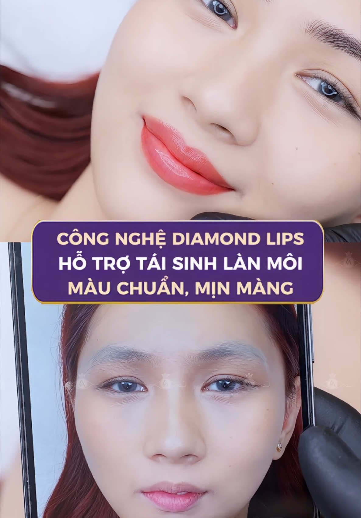 Tái sinh môi thâm trở nên hồng hào với công nghệ cấy Diamond Lips tự nhiên, trong trẻo với ƯU ĐÃI GIẢM 65% - Đăng ký ngay tại đây #thammylinhanh #lamdep #phunmoi #caymoidiamondlips #phunmoidep #phunmoikithuatchauau #phunmoitebaogoc #caymoisinhhoc 