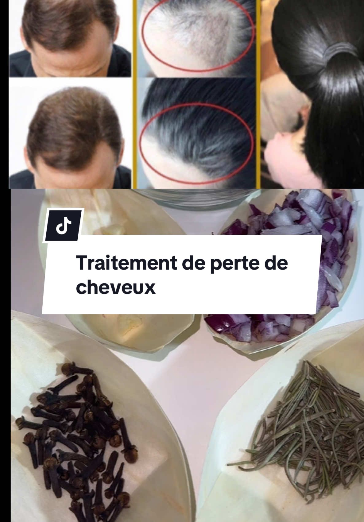 Traitement de perte de cheveux#pertecheveux #longcheveux #poussecheveux #remedenaturel #ftpシ  @وصفات  @وصفات  @وصفات 