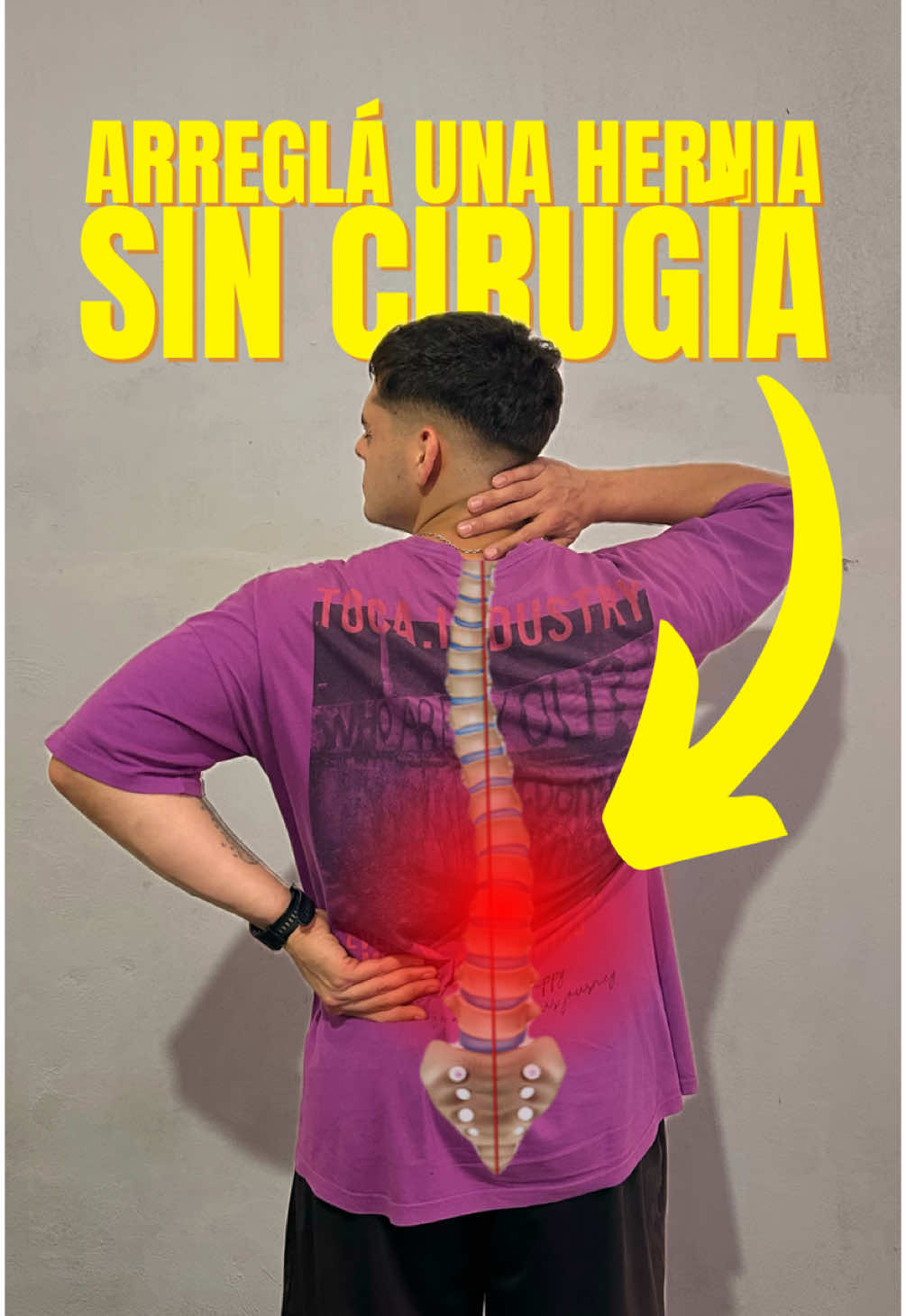 ARREGLÁ una HERNIA sin CIRUGÍA 😱 La hernia de disco lumbar es una de las lesiones más comunes y temidas, pero tengo buenas noticias: en la mayoría de los casos, puedes resolverla sin necesidad de cirugía. Esta condición ocurre cuando el material interno del disco intervertebral sobresale, pudiendo comprimir estructuras nerviosas cercanas y causar dolor. Sin embargo, el 98% de los casos responden favorablemente a un manejo conservador basado en ejercicios específicos y ajustes posturales. Uno de los errores más comunes es intentar aliviar el dolor estirando la espalda baja. Aunque puede parecer una solución lógica, este tipo de estiramientos muchas veces empeoran la situación al aumentar la presión sobre el disco dañado. En su lugar, la clave para la recuperación está en técnicas de descompresión y extensión, diseñadas para reducir la presión sobre el disco afectado y realinear las estructuras lumbares. Un ejercicio muy efectivo para la descompresión de la columna es colgarse de una barra para dominadas. Al permitir que la pelvis caiga libremente, se genera espacio entre las vértebras, reduciendo la compresión sobre los nervios y los discos. Este ejercicio puede realizarse dos o tres veces por semana, manteniéndose colgado entre 30 y 60 segundos por serie, según la tolerancia y el progreso individual. Si tu dolor aparece cuando te inclinas hacia un lado, la prioridad es corregir la postura. Para esto, apóyate en una pared con la espalda recta y los hombros relajados, asegurándote de mantener una alineación adecuada. Después, puedes realizar extensiones lumbares acostado boca abajo. Este ejercicio, conocido como “cobra”, consiste en levantar lentamente el torso mientras mantienes las caderas en contacto con el suelo. Haz 2 a 3 series de 10 a 12 repeticiones al día, enfocándote en movimientos lentos y controlados, sin llegar al dolor. Estos ejercicios no solo alivian el dolor, sino que también preparan tu columna para retomar tus actividades habituales, incluyendo el entrenamiento, sin limitaciones ni molestias. . . . . . #hernia #fisio #gym #gymtips #gimnasio #Fitness #entrenamiento #hipertrofia #fit #gymrat #recovery #injury #backpain #backday