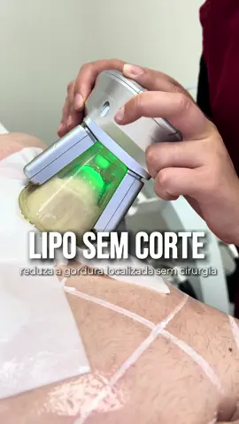 O Crio Redux é uma solução eficaz para quem deseja reduzir medidas tanto no abdômen quanto no tórax. ❄️💪 O tratamento promove o congelamento da área, fazendo com que a célula de gordura sofra a apoptose (morte celular). Em apenas uma única sessão pode transformar seu corpo de forma segura, eficaz e com resultados comprovados cientificamente. Quer saber mais sobre como o Crio Redux pode atender às suas necessidades? Agende sua avaliação!