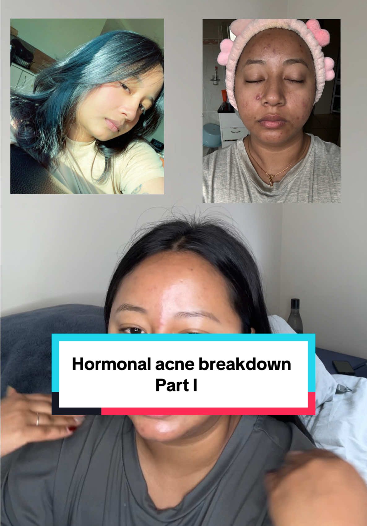 Hormonal acne breakdown #nz #nztiktok #nznepali #PR #fy #fyp #fyppppppppppppppppppppppp #trending #viral #trendingvideo #australia #nepalimuser #teamworkmakesthedreamwork #trending #fashion #teamwork #girlssupportgirls #nzpunjabi #nepalitiktok #skincare #acnetreatment #hormonalacne #pimple #kskincare 