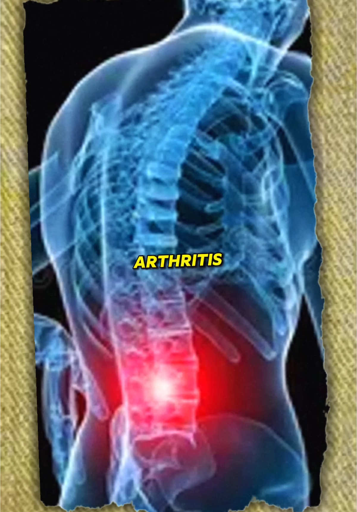 Why does my back hurt? Arthritis gets worse over time because of wear and tear on your joints. As you age, the cartilage that cushions your joints can break down, and the muscles around those joints get weaker. This makes it harder for your body to support itself, which leads to more pain and stiffness. To slow down arthritis, it’s important to stay active. Strengthening muscles around the joints can help absorb pressure and protect them, reducing pain and improving mobility. #arthritis #painmanagement #backpain