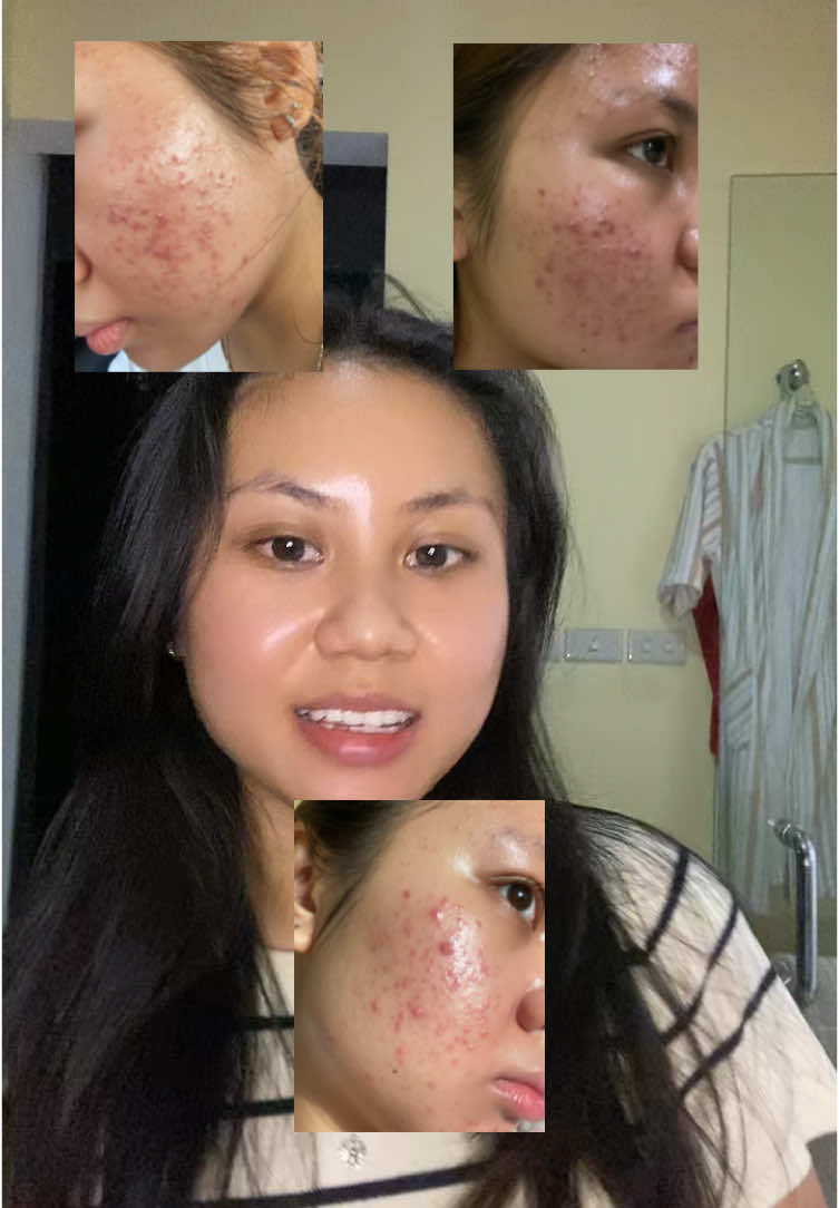 Skincare and yap 🥹 anyway ini skincare aku di hari kamis untuk bantu nyembuhin dan hilangin jerawat 😋 #acne #acnetreatment #acneskin #acnefighter #acneproneskin #skincare #skincaretips #acnejourney #jerawat #jerawathilang #fy #koreanskincare #koreanskincareproducts #kbeauty #bekasjerawat @ILLIYOON Indonesia @ANUA Indonesia @TIRTIR INDONESIA @Bioderma Indonesia @beautyofjoseon.id 
