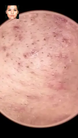 #squeeze #squeezeyuk #acne #pimple #pimplepop #blackhead #satisfyingvideos #fyp