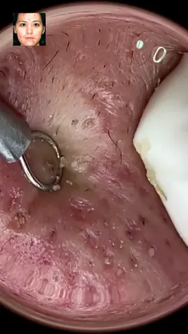 #squeeze #squeezeyuk #acne #pimple #pimplepop #blackhead #satisfying videos #fyp
