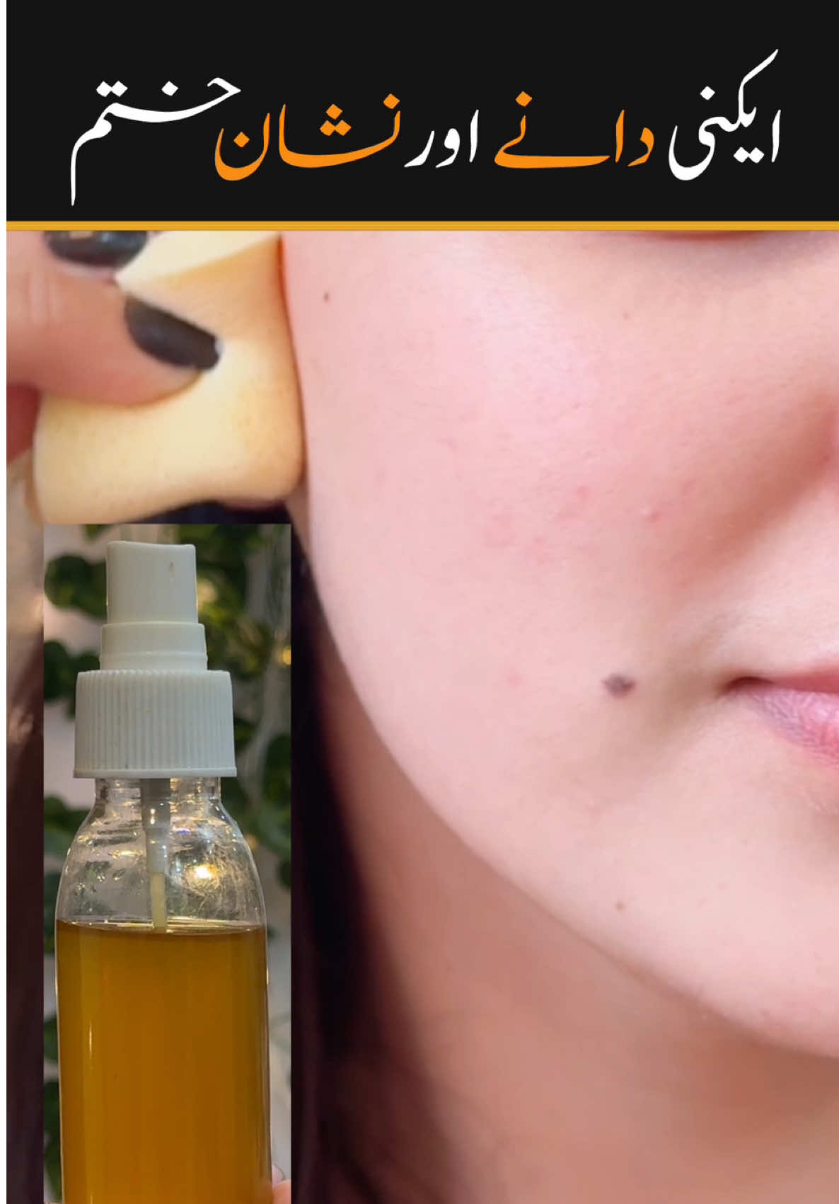 Acne removal serum #faceserum #acnetreatments #skincare #skinglow #shumailasdiary 