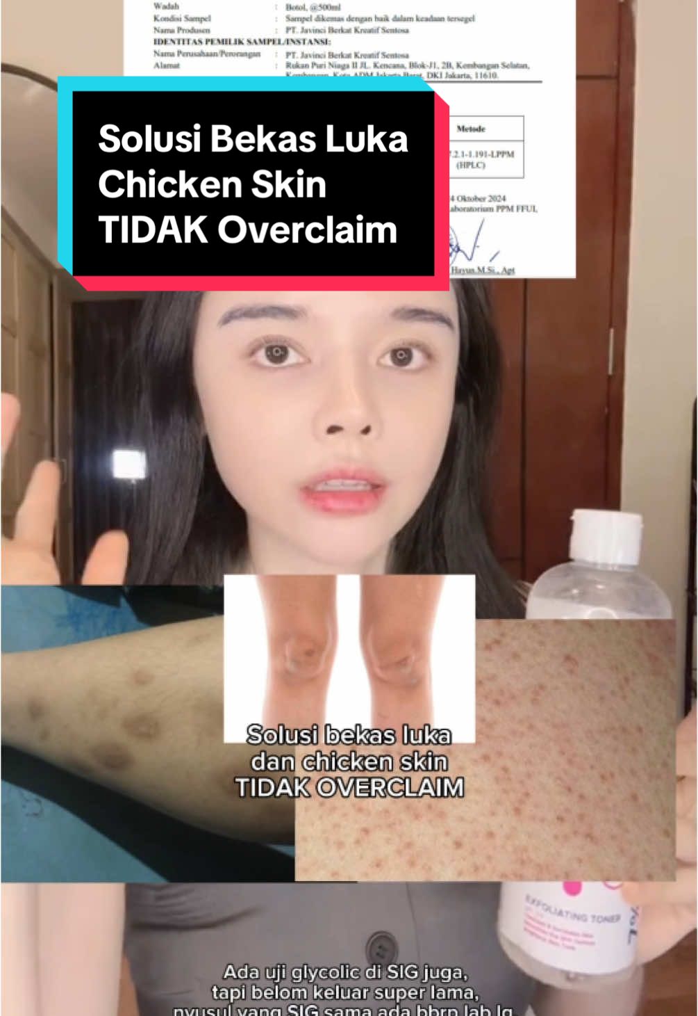 Nih ya yang udah ditunggu2. Hasil lab dari Lab Universitas Indonesia glycolic acidnya di 6,72%, ada diuji di beberapa lab lainnya juga termasuk SIG tapi belum keluar sampe hari ini. Dari SIG yang udah tuh niacinamide dy ada di 5%. Intinya ga overclaim, udah rame yang ngeluh kulit ngelupas dan kering pakai ini soalnya ga dipakein pelembab. Iya harus pelembab ya namanya juga chemical exfoliant/mengangkat sel kulit mati. Perlu pelembab untuk sel kulit baru yang lebih cerah dan halus untuk tumbuh. Hati2 ya pakainya kalo pemula banget mending seminggu sekali dulu. Banyak yg di 5% aja udah kering banget. #autumn #toner #tidakoverclaim #chickenskin #keratosispilaris #hasillab #sig #ui #glycolicacid #aha #chemicalexfoliant #lamabanget #acne #acnefighter #bekasluka #gelap #pih #kehitaman #cerah #halus