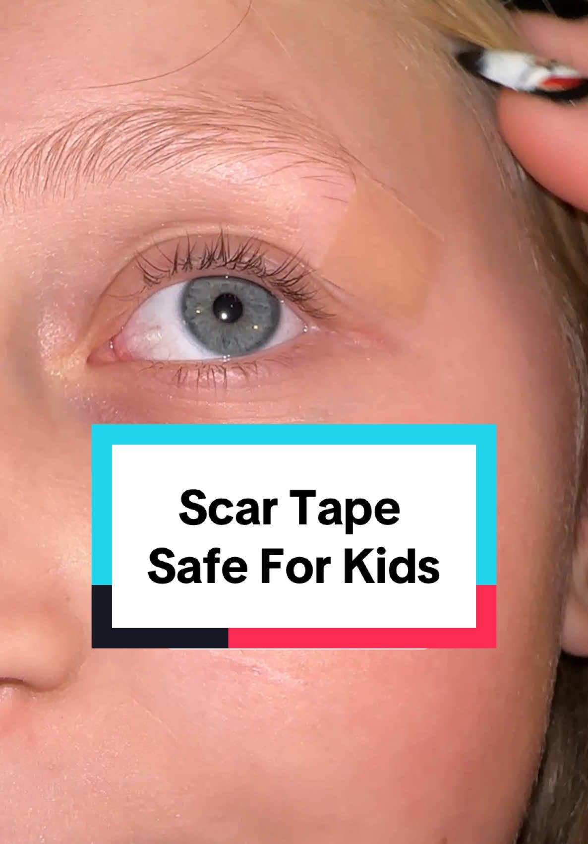 Scar Tape is a great alternative to scar creams! I use this on my kids and for areas of my body like scars near my eyes as a safer option!#scar #scartape #scarhealing #surgery #injuryrecovery #scarreduction #scarsheets #beautifulgirl #holidayhaul 