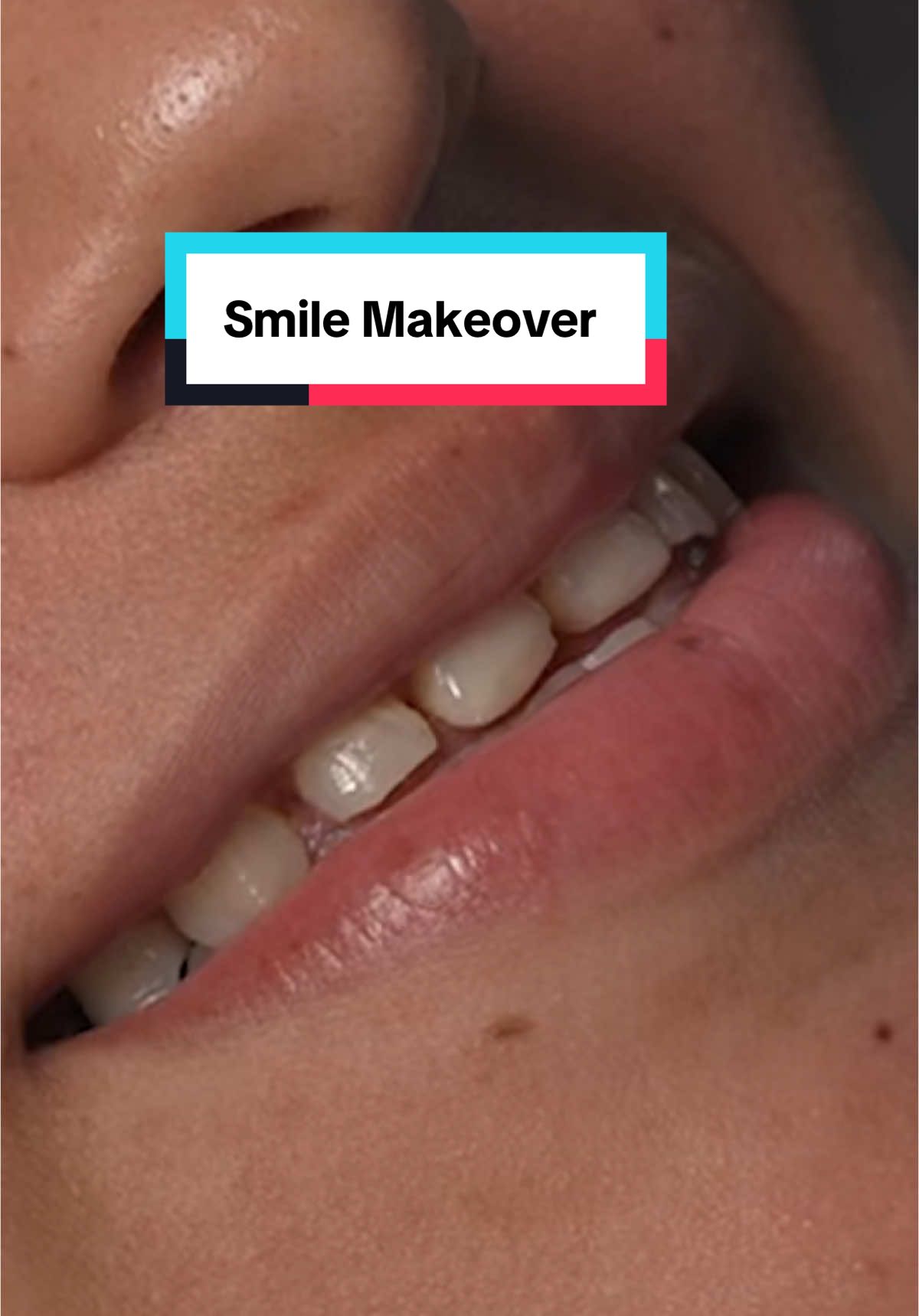 Loving this new smile makeover #veneers #beforeandafter #transformations 