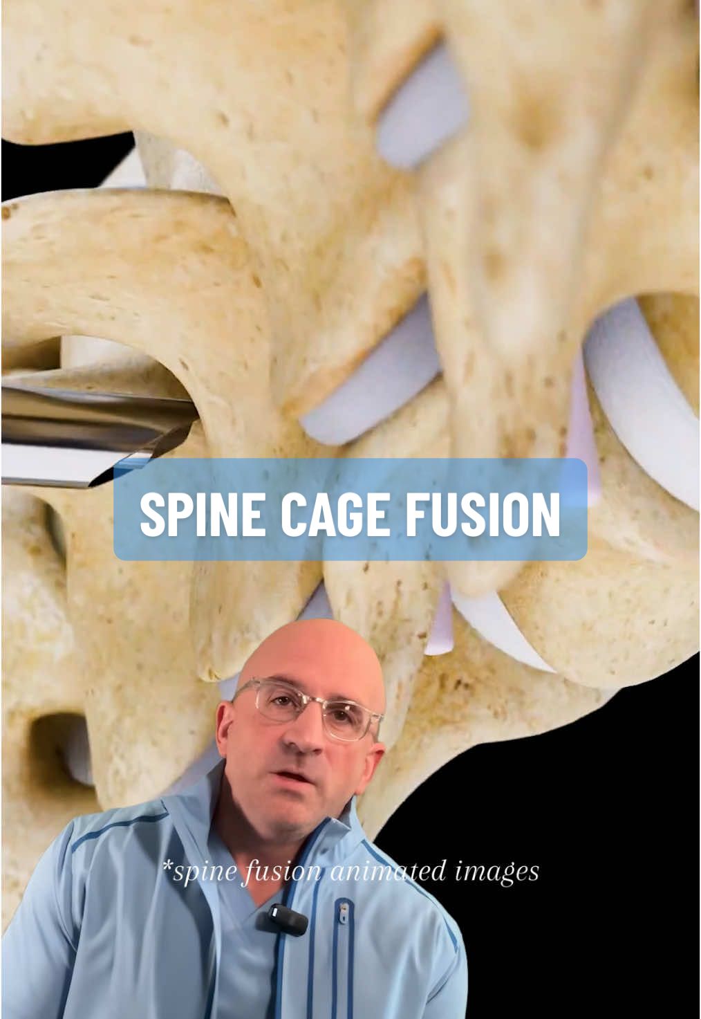 Expandable Spine Cages in Fusion Procedures for Back Pain Relief - Expandable spine cages represent a significant innovation in spine fusion surgery. Expandable #SpineCage devices start small during insertion and expand once properly positioned, offering surgeons optimal control and precision in restoring proper spine alignment and disc height. Unlike traditional static cages, expandable cages can be inserted through smaller incisions and expanded in multiple directions, reducing nerve retraction + potential tissue damage. Latest designs feature both vertical expansion for height restoration + medial-to-lateral expansion for improved endplate coverage for:   • Minimally invasive insertion #SpineSurgery   • Customizable expansion to fit patient anatomy   • Reduced risk of endplate damage   • Improved surgical outcomes . Recent clinical studies show that expandable cages can achieve superior segmental lordosis correction vs. static cages, with some designs offering up to 20° of lordotic correction. However, proper surgical technique and careful expansion are crucial to prevent subsidence. Some newer expandable cages incorporate 3D-printed titanium surfaces designed to enhance bone integration and fusion rates. Always consult with an experienced, qualified spine specialist to determine the best treatment options for your specific condition. #discdegeneration #backpain  . 👇 SHARE your spine disc disease experience & insights. Comment 