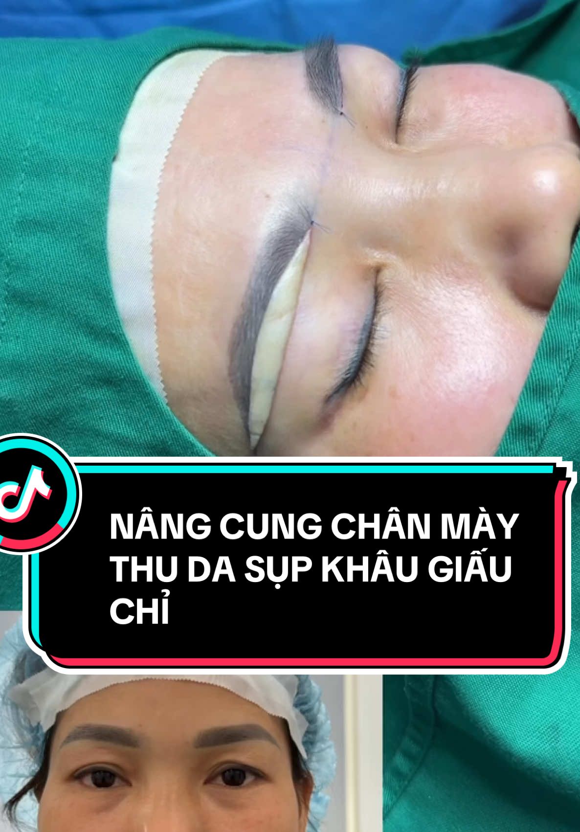 Case NÂNG CUNG THU DA XOÁ NHĂN KHÂU GIẤU CHỈ trả c khách cs Hà Nội #viral #trendingvideo #dr #Hiền_Triệu #làm_đẹp #pttm #MH #TikTokAwardsVN #tiểu_phẫu #nângcungchânmàydấuchỉ 