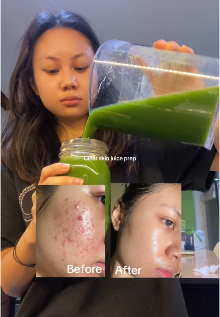 Kalau kulit kalian jerawatan, cobain rutin minum jus detox dehh…beneran lebih ampuh daripada skincare 🤩💞 #acne #acnetreatment #acneskin #acnefighter #acneproneskin #skincare #skincaretips #acnejourney #jerawat #jerawathilang #fy #greenjuice #detox #bekasjerawat @Kuvings.id 