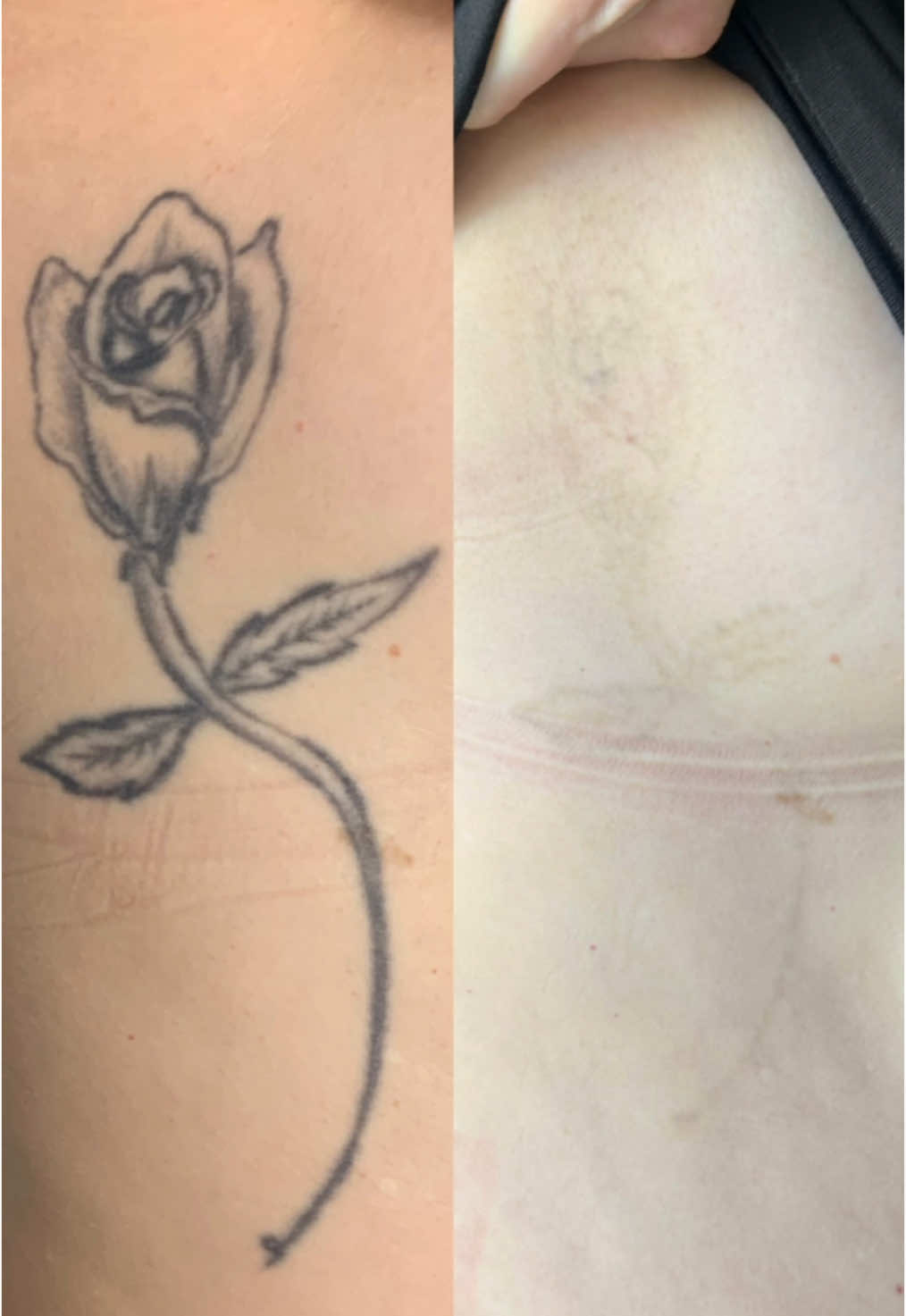 3 TREATMENTS! When researching where to go for your tattoo removal, make sure they have great before and after results and are transparent about the number of treatments it takes them and the time frame of the removal too.  FREE QUOTE👇🏻 📍: CBD 0466882965 📍: WINDSOR 0466425316 📞: @swifttattooremoval 💌: swifttattooremoval.com.au  #tattooremoval #beforeandafter #tattooremovalmelbourne #melbournetattooremoval #swifttattooremoval #laser 
