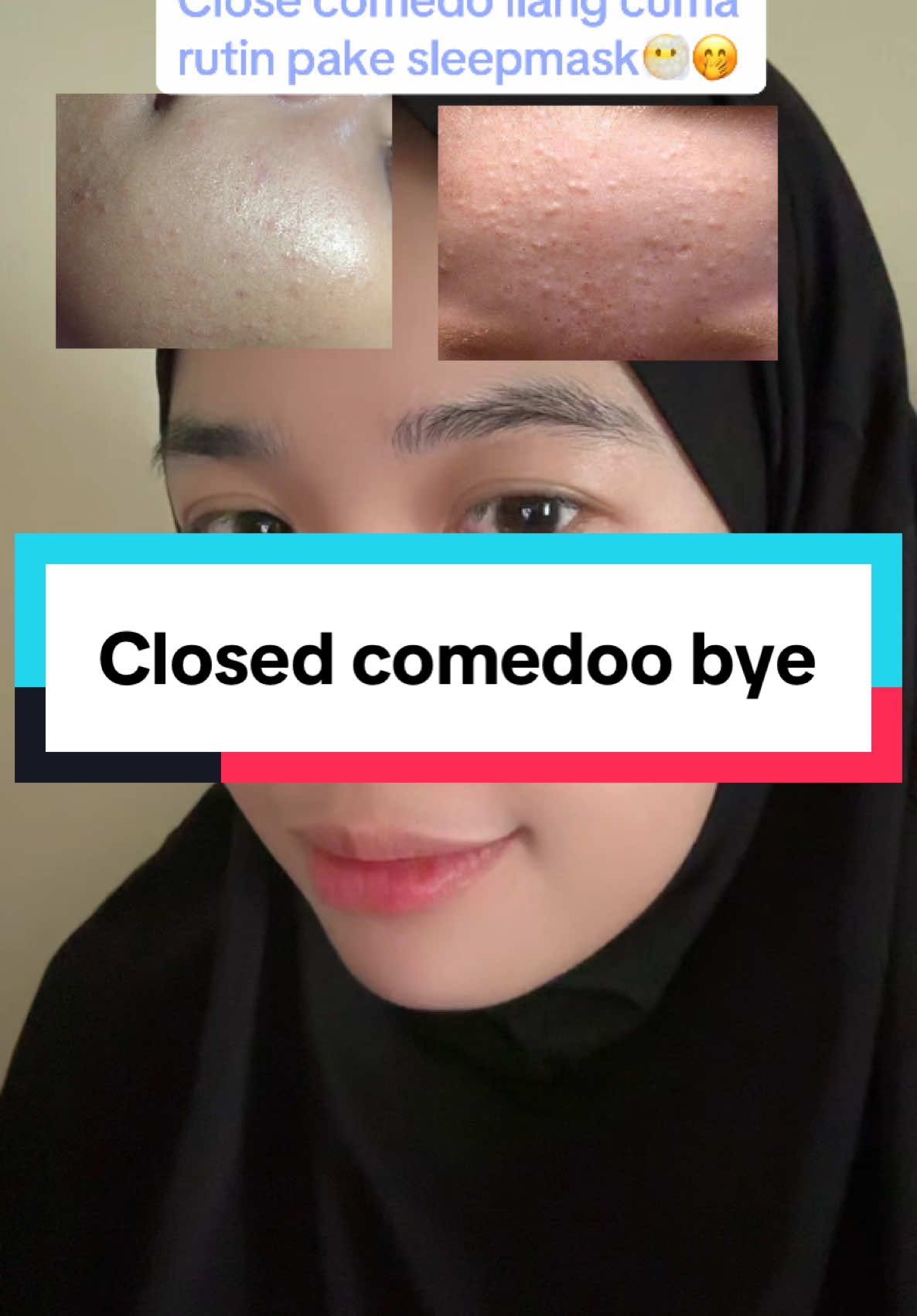 Tiap pake tuh bangun paginya kagum,pada mateng 😆 #sunscreen #sleepmask #sleepmaskbybdka #closecomedo 