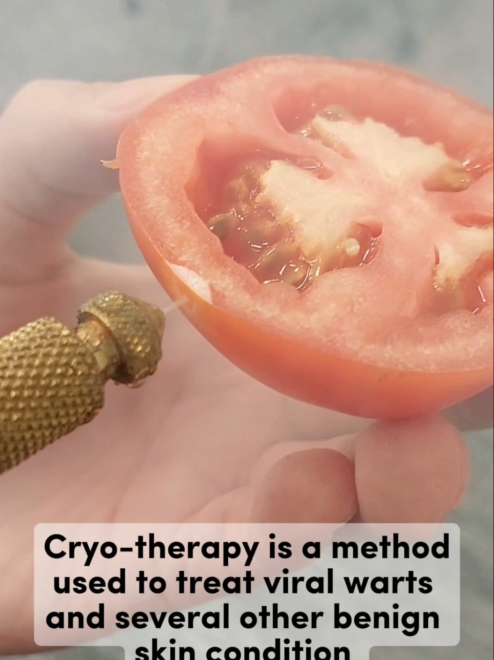 Have you wondered how is cryotherapy done? #CapCut #medicine #cryotherapy #liquidnitrogen #skin #viralwarts #dermatology 