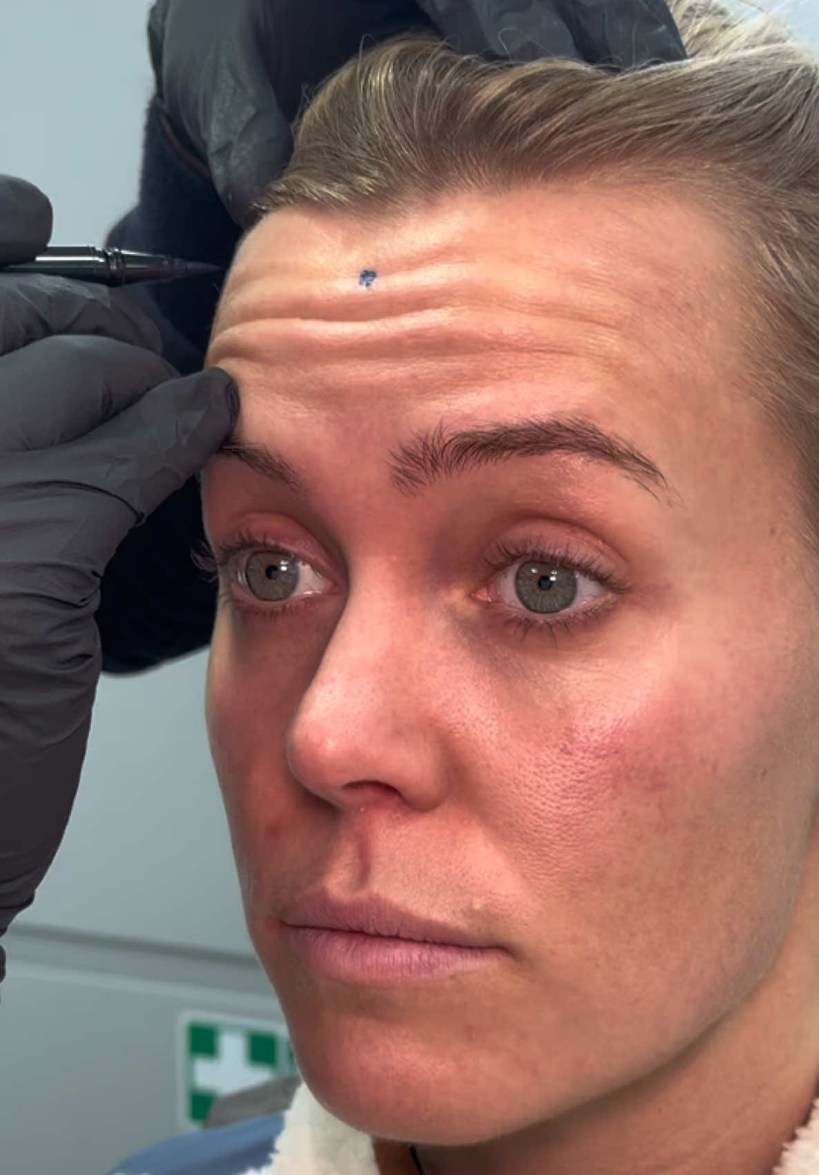 MAKE SURE TO SAVE THIS TECHNIQUE FOR FUTURE USE 👋  @DrSomjiSkin demonstrates injecting Botox into three areas for Chloe Meadows - forehead, glabella, and crow’s feet while while carefully balancing placement and dosage to avoid eyebrow droop 👏 #botoxinjections  His technique focuses on strategic injection points and maintaining the frontalis muscle’s natural lift, ensuring smooth yet natural-looking results 🙌🏼 Chloe will be back in a week at DrMedispa, and we will show you the before and after!😍  #facialrejuvenation #botulinumtoxin #antiaging  Have you ever experienced brow dropping after Botox?