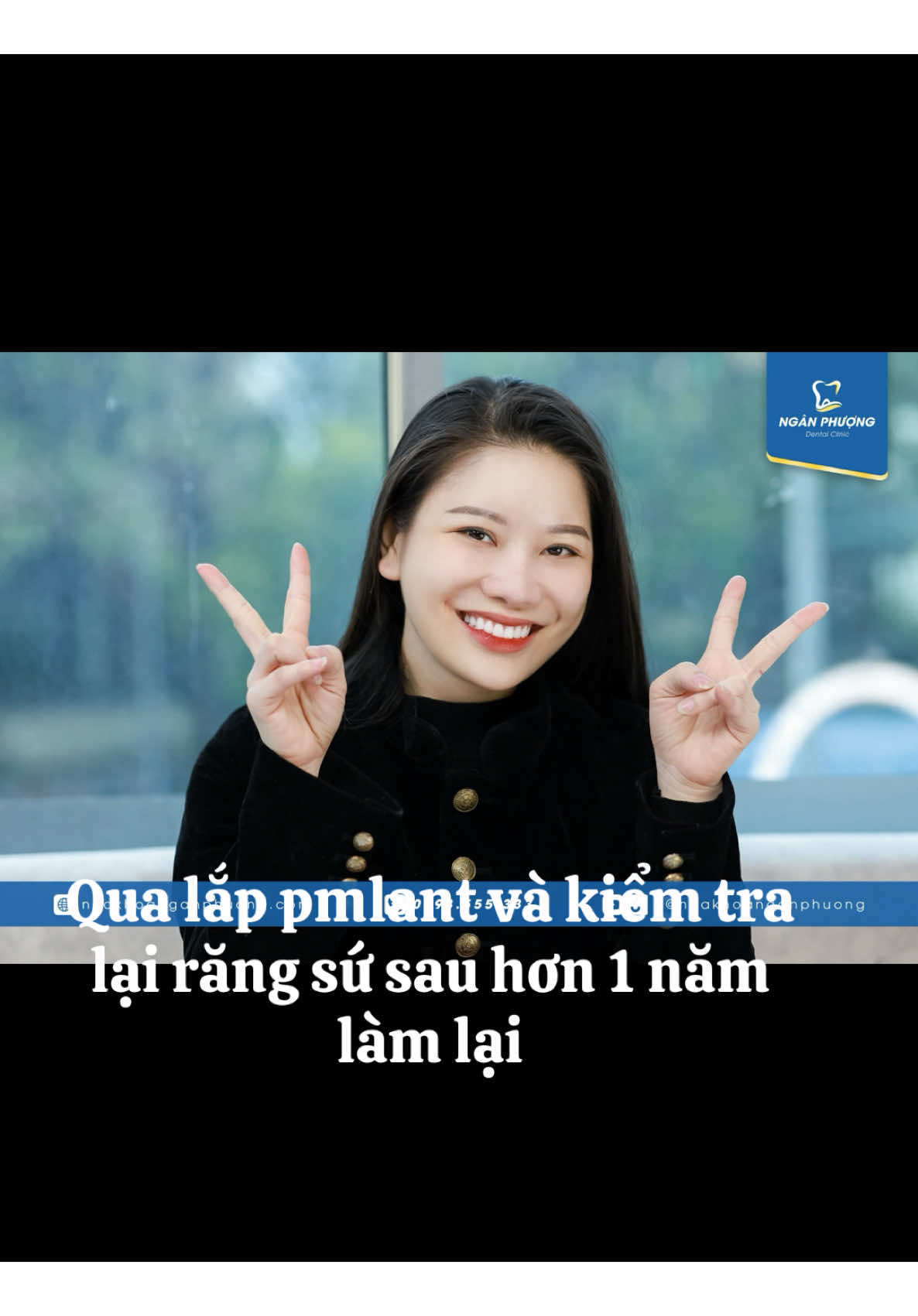 Lợi đẹp hơn mong đợi sau 1 năm xử lý lại#vietkieu #rangsuthammy #chuaviemloi #nhakhoanganphuong #drtuan 