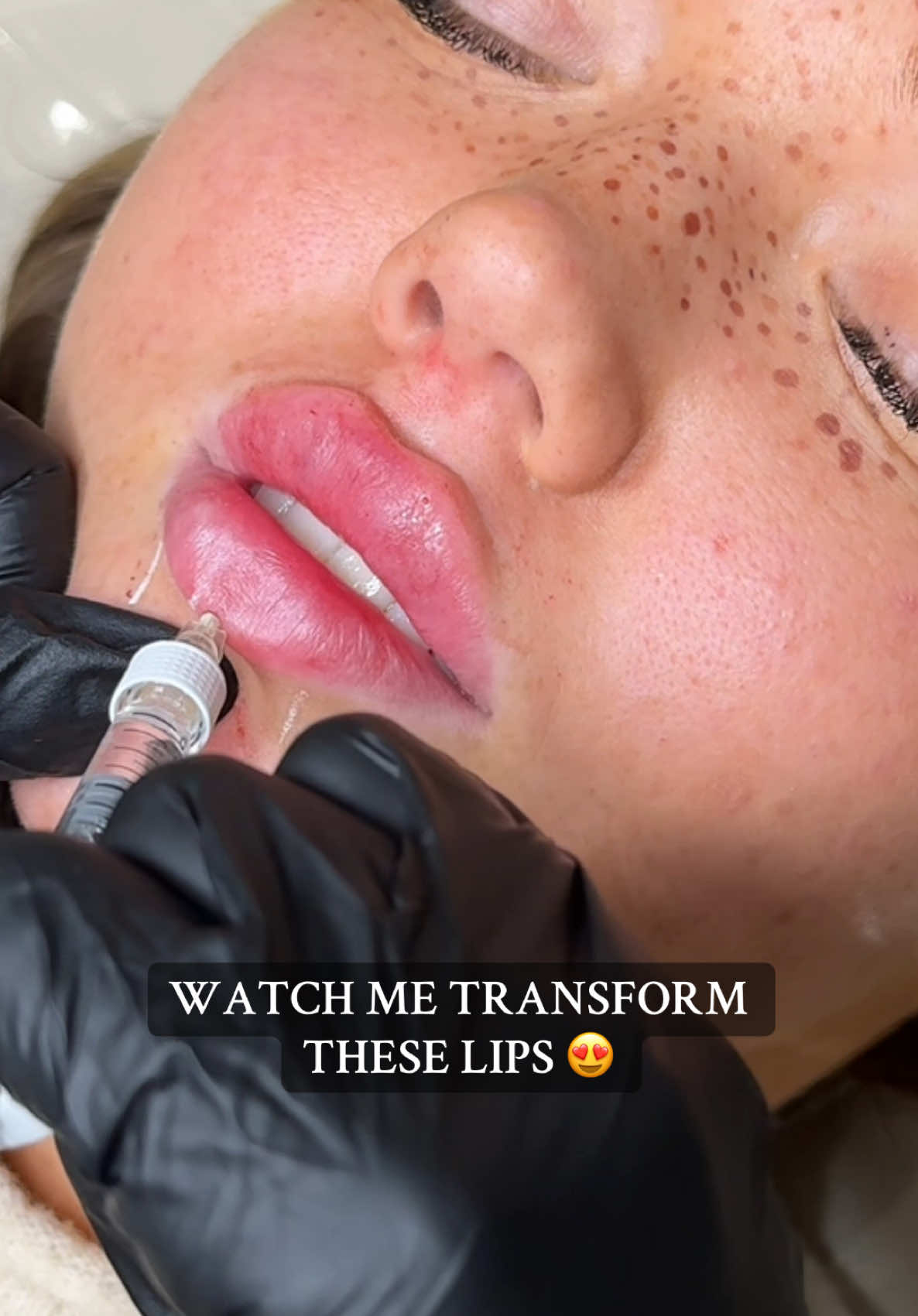 A little snippet of the process 😍 #lipfiller #russianlipstechnique #russianlips #flatlips #advancedliptechniques #aestheticspractitioner #fyp #foruyou 