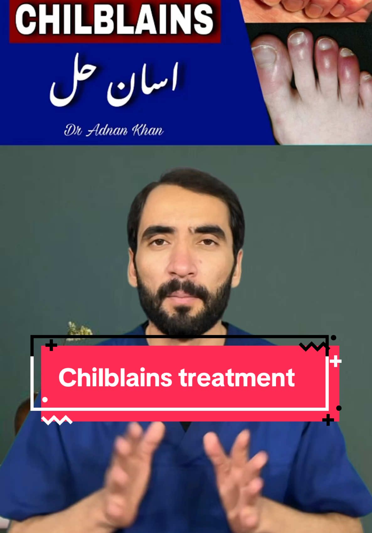 Treatmenr Of Chilblains #dradnankhan #pashtotiktok #healthawareness #doctor #pakistan #afghanistan #chilblains #wintervibes 