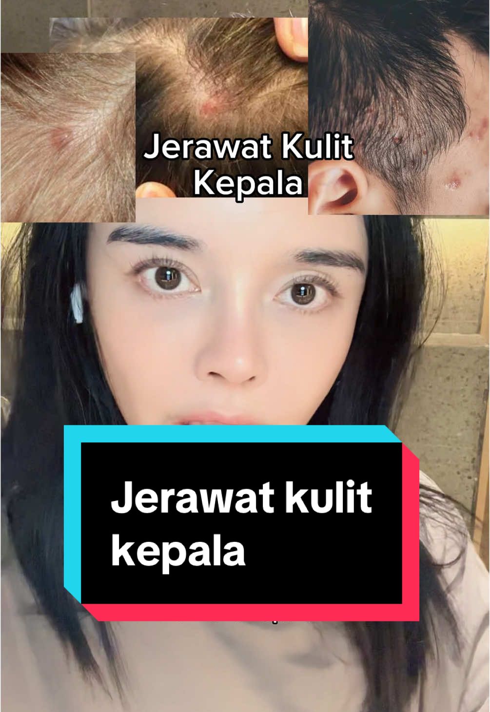 Sama aja ya jerawat di kulit kepala itu penyumbatan di pori2 kulit kepala bedanya sih di kulit kepala ada rambut jadi lebih sulit karena bisa jadi folikulitis, infeksi pada akar rambut. Bisa dicoba dulu pakai sampo salicylic acid, tea tree atau sulfur atau totol obat anti acne di jerawat di kulit kepala. Bila jumlahnya banyak dan besar, ada baiknya ke dokter karena bisa diberikan obat minum dan antibiotik. Sampo salicylic acid juga bagus banget buat rambut lepek jadinya volumizing dan ga cepat minyakan lagi setelah keramas. #jerawat #jerawatkulitkepala #salicylicacid #shampoo #rontok #radang #infeksi #skincare #haircare #scalp #lepek #antilepek #hyaluronicacid #antiinflammatory #scalpfolliculitis #kulitkepalabersih