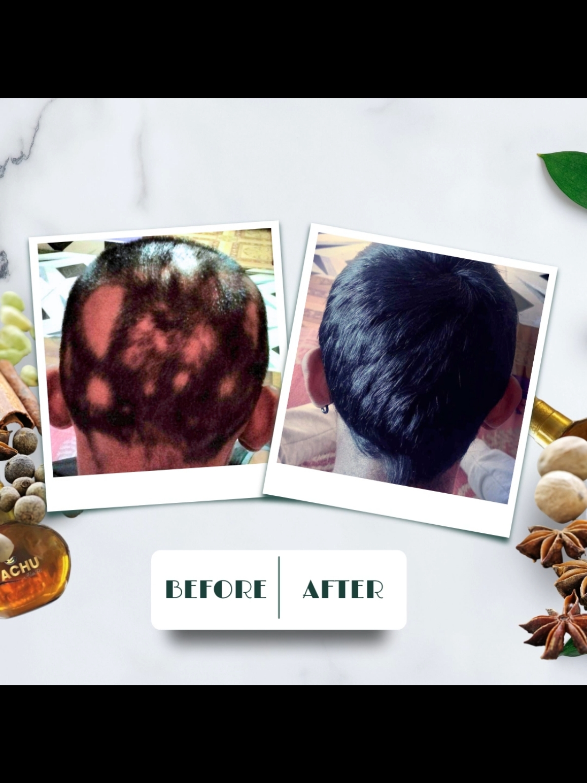 The ultimate cure for alopecia cases... #fyp #follow #trending #tiktok #tiktoknepal 