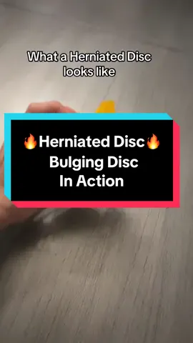 Have you been diagnosed with a disc herniation? #herniateddisc #discbulge #sciatica #backpain #backpainrelief #nervepain