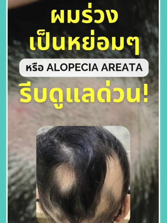 ผมร่วงเป็นหย่อม รีบดูแลด่วน‼️ สนใจทักแชท 💬 ปรึกษาดูแลปัญหากับ Trichologist ผู้เชียวชาญด้านเส้นผมและหนังศีรษะเท่านั้น ที่ harley st. hair centre  #harleyhaircentre #แชมพูลดผมร่วง   #ผมร่วง #ผมบาง #hairloss #ผมร่วงเป็นหย่อม #วิกผม #แฮร์พีช #hairlosstreatment #haircare #ขจัดรังแค #แชมพูปลูกผม #เซรั่มปลูกผม #ศีรษะล้าน #รังแค #ผมมัน #รังแคเยอะจัด #หัวล้าน #คันหัว #ปลูกผม #thailand #แชมพู #แชมพูสมุนไพร #แชมพูปิดหงอก #เซรั่ม #ลดผมร่วง #เซรั่มปลูกผม #โหนกระแส #lyothailandofficial #onebangkok #iconsiam #จุฬา #แชมพูศิริราช #โรงพยาบาลบำรุงราษฎร์ #siamparagon #สยาม #โรงพยาบาลกรุงเทพ #ข่าววันนี้ #สีลม #บางนา #ลาดพร้าว #รังสิต #ช๊อปมันส์วันเงินเดือนออก #ของดีบอกต่อ #คริสต์มาส2024 #คริสต์มาสนี้ที่tiktok #ข่าวล่าสุด #tiktokshop1212ลดใหญ่ท้ายปี  #tiktokshopช้อปกันวันเงินออก #hair #Trichologist #hairtonic #hairtiktok #hairtransformation #hairgrowth #healthyhair #thinninghair #greyhair #humanhair #MLBB8TH 