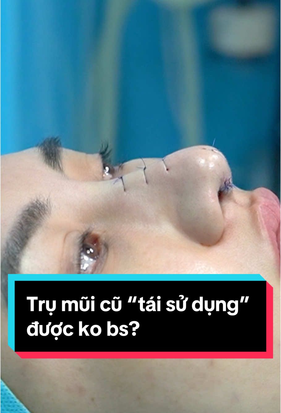 Bạn này từng nâng cấu trúc có dựng trụ nhưng không hài lòng vì thô, cứng quá. Bạn đến bs tưởng bs sẽ yêu cầu làm cấu trúc lại toàn bộ, không ngờ bs lại chọn 1 phương án nhẹ chi phí hơn, “tái sử dụng” trụ mũi cho bạn. #bacsitranphuong #viennangmuidrface #chuyensaunangmui #pttm #lamdep #nangmuisunsuon #nangmuiantoan #nangmuicautruc #phuongphapnangmui #nangmuitienme #nangmuikhongdau #vatlieunangmui #emlakedangthuong 