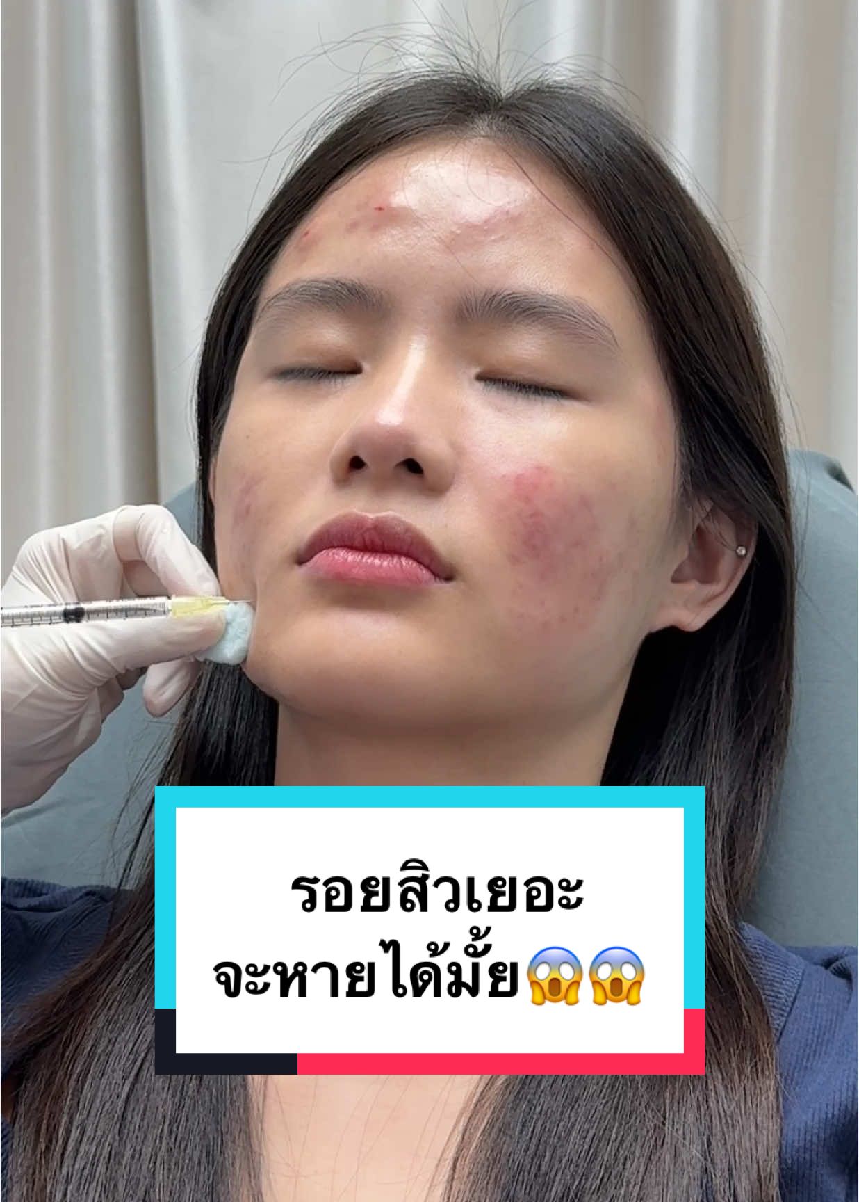 จบทุกรอยสิว แถมได้ผิวแข็งแรง ต้องมาเด้ + ออร่าไบร์ท‼️ #รีวิวฉีดหน้า #รีวิว #รีวิวบิวตี้ #รีวิวบิวตี้ในtiktok #รีวิวของดีบอกต่อ #รีวิวคลินิก #ฉีดหน้าใสออร่า #ฉีดหน้าใส #รอยสิว #รอยดำ #รอยแดง #รอยดำรอยแดง #รอยดำจากสิว #หน้าใส #หน้าเนียน #หน้ากระจ่างใส #หน้าใสไร้สิว #หน้าใสไร้รอยสิว #สิว #ผิวแข็งแรง 