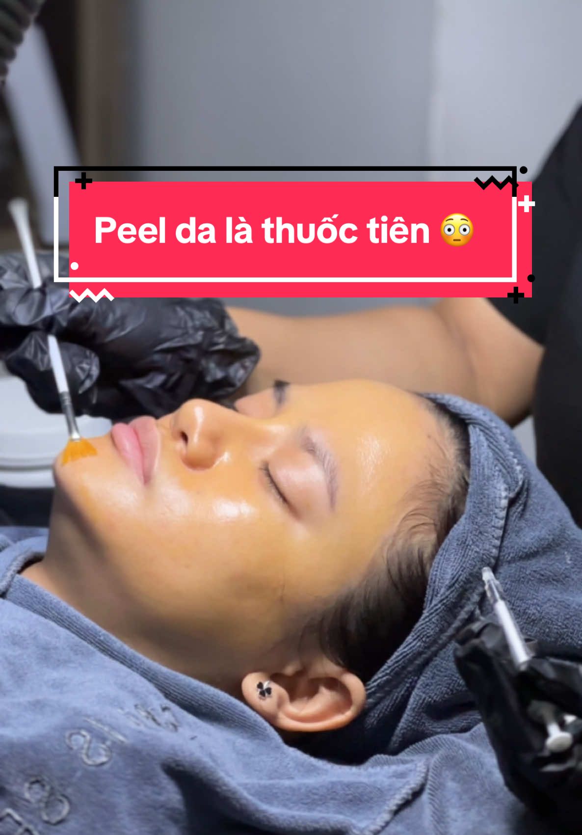 Peel da là thuốc tiên … vì có thể giải quyết được các vấn đề cho da 😳 #bovisspa #spadanang #spadananguytin #spauytin #spauytindanang #trịmụn #trịnhđanny #trịthâm #trimun #trimuntritham #trimunchuanykhoa #laynhanmun #laynhanmunchuanykhoa #laynhanmunsachsau #laynhanmuntambong #laynhanmundanang #trehoada #peel #peelda #peeldamun #peeldacangbong #spadanangchuyendieutri #nanmun #nanmunchuanykhoa 