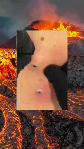 #squeeze #squeezeyuk #acne #pimple #pimplepop #blackhead #satisfyingvideos #fyp