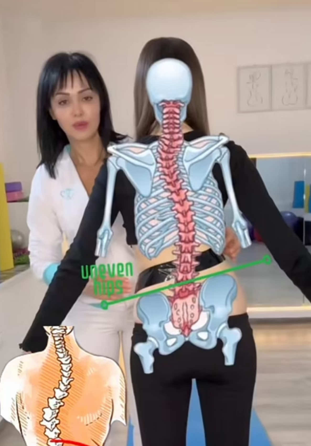 Uneven hips? No worries! Try this simple exercise to improve alignment and balance. Visit verginiacenter.com for more tips and expert guidance! #scoliosis #unevenhips #սկոլիոզ #الجنف #hipalignment #healthyspine #posturecorrection #انحناء_الظهر 