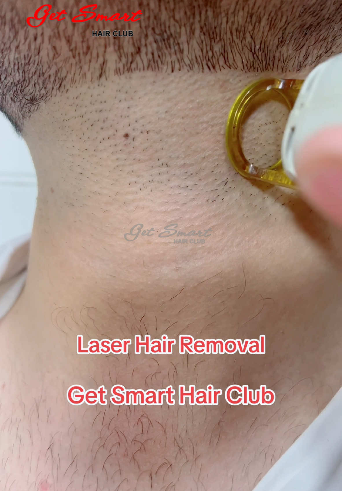 Laser Hair Removal #getsmarthairclub_ #peshawar #viralvideo #fypシ #trending #follow #hair #funny #laser #viral #foryourpage #DilKiBaat #video 