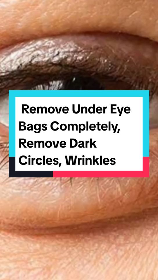 Remove Under Eye Bags Completely, Remove Dark Circles, Wrinkles, Puffy Eyes #UnderEyeBags #DarkCircles #WrinkleTreatment #PuffyEyes #SkinCare #HomeRemedy #EyeCare #HealthySkin #NaturalBeauty #BeautyTips