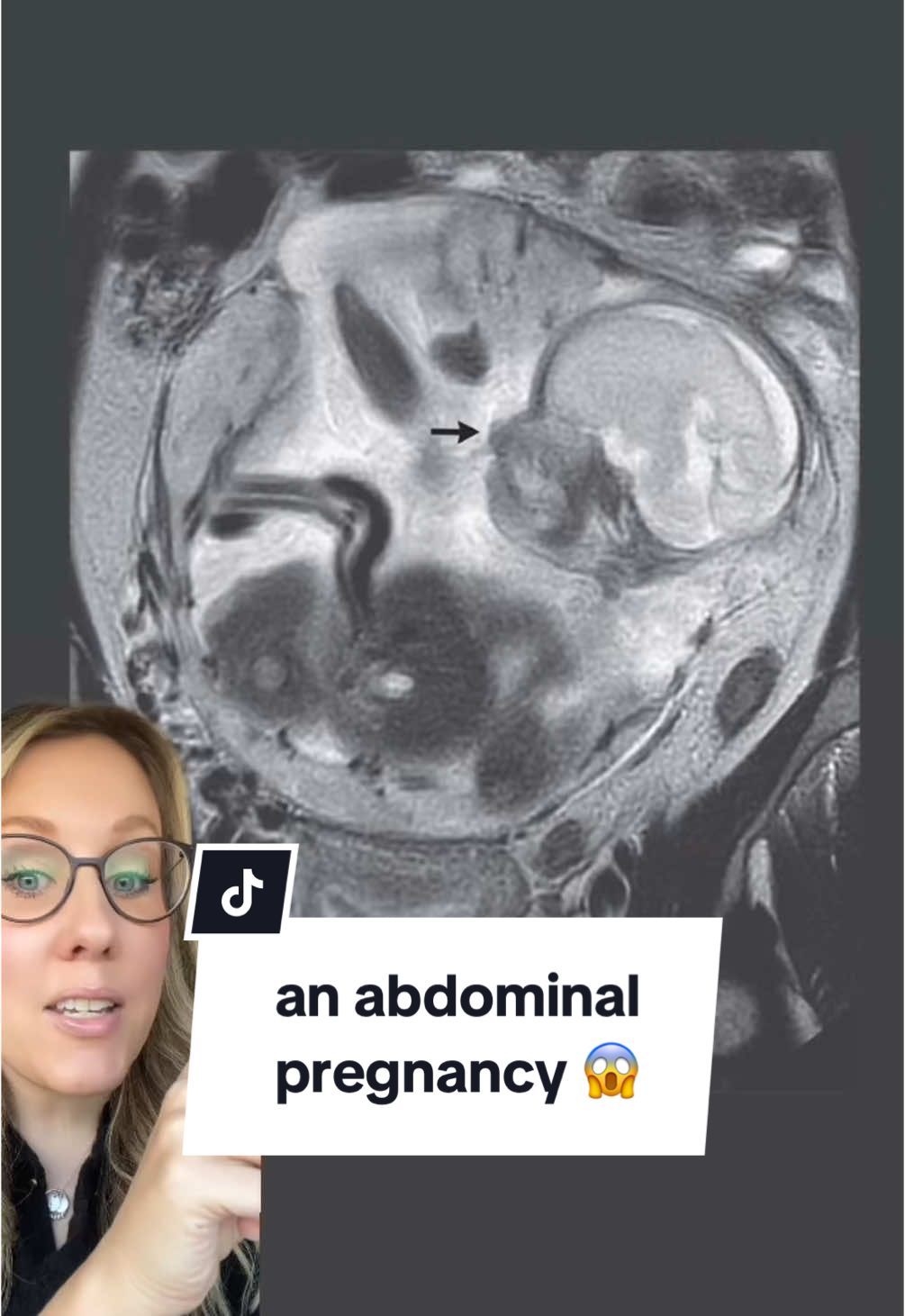 who knew a pregnancy could even end up there! 😱 #abdominalpregnancy #ectopicpregnancy #obgyn #pregnancy