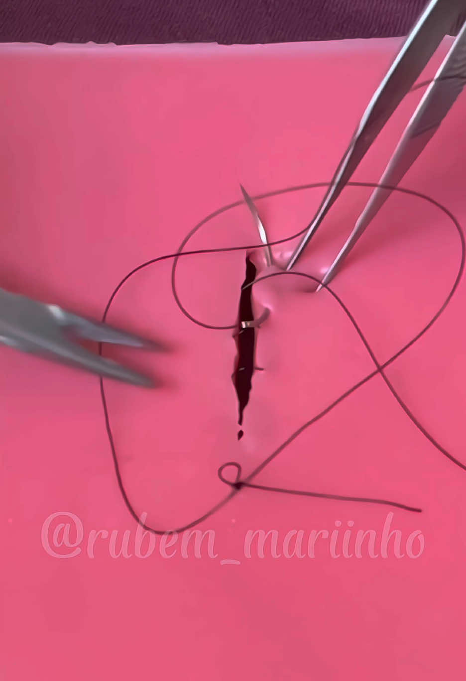 Intradérmica suture ✅ Plastic suture ✅ Subcuticular #pontocirurgico #suturas #medicina #nurse #medicalstudent #cirurgia #intradermica #plastic #subcuticular 