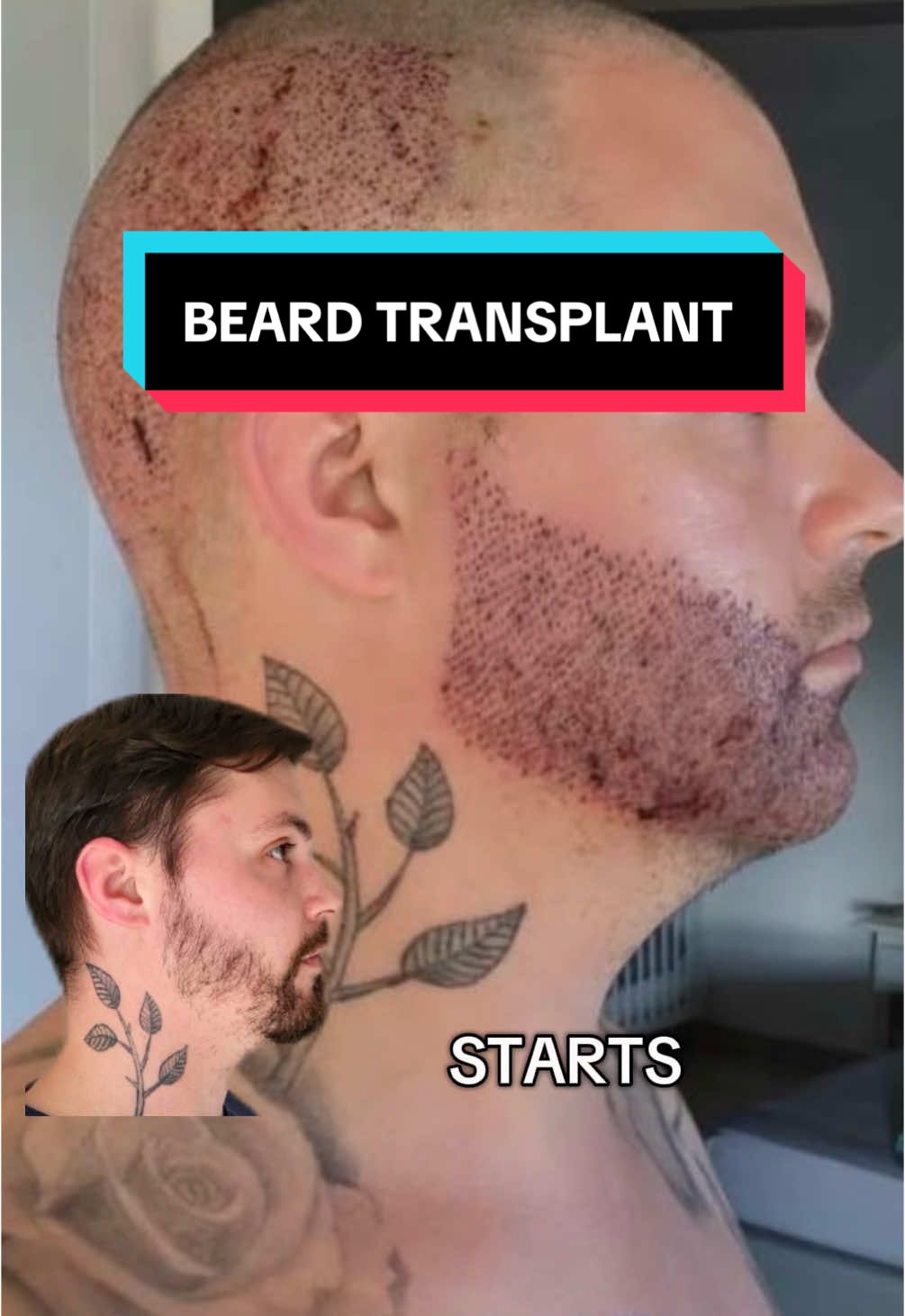 BEARD TRANSPLANT 🚨#beardtransplant #hairtransplant #greffedecheveux#bellahair 