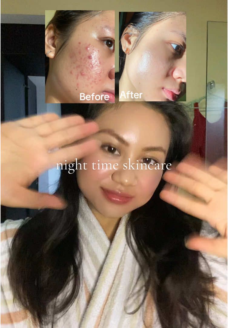 Asmr night time skincare 🤩 walaupun minum skincare lebih efektif, kalau kulit kalian jerawatan kaya aku harus tetep skinkeran yeaaa #acne #acnetreatment #acneskin #acnefighter #acneproneskin #skincare #skincaretips #acnejourney #jerawat #jerawathilang #fy @ILLIYOON Indonesia @ANUA Indonesia @skin1004indonesia @SKIN1004 ID Official @Torriden Indonesia 