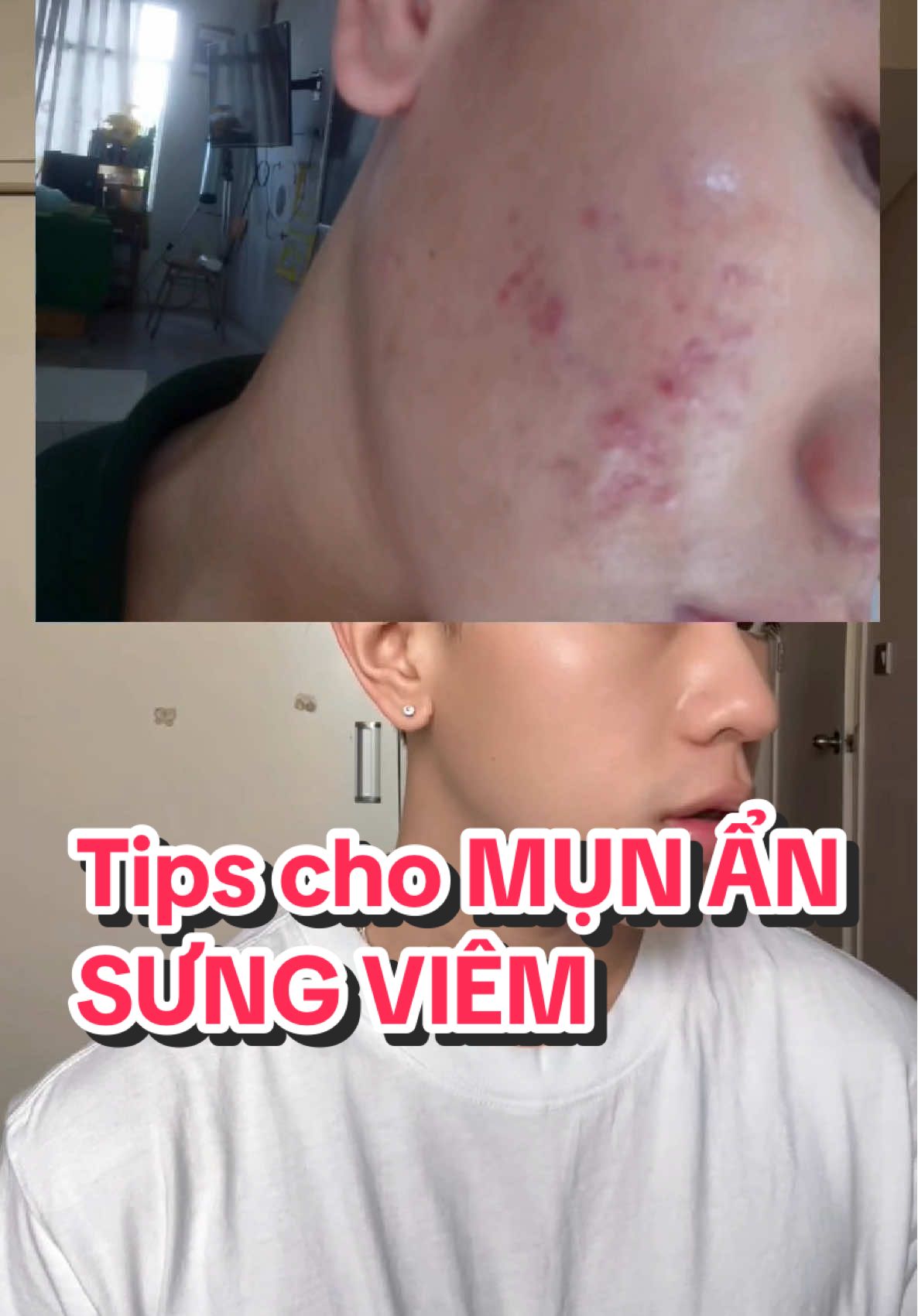 Tips cho MỤN ẨN, MỤN SƯNG VIÊM với 1 tuýp chấm mụn giá học sinh, sinh viên!  👉 Tham khảo ngay: Cafuné Flux Derma Gel #thecafune #cafuneflux #mun 