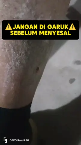 JANGAN DI GARUK SEBELUM MENYESAL❌,,Olesin aja dengan Salep Youzhi yang sudah terbukti ampuh mengatasi berbagai masalah gatal-gatal,Sudah BPOM & Halal jadi aman digunakan