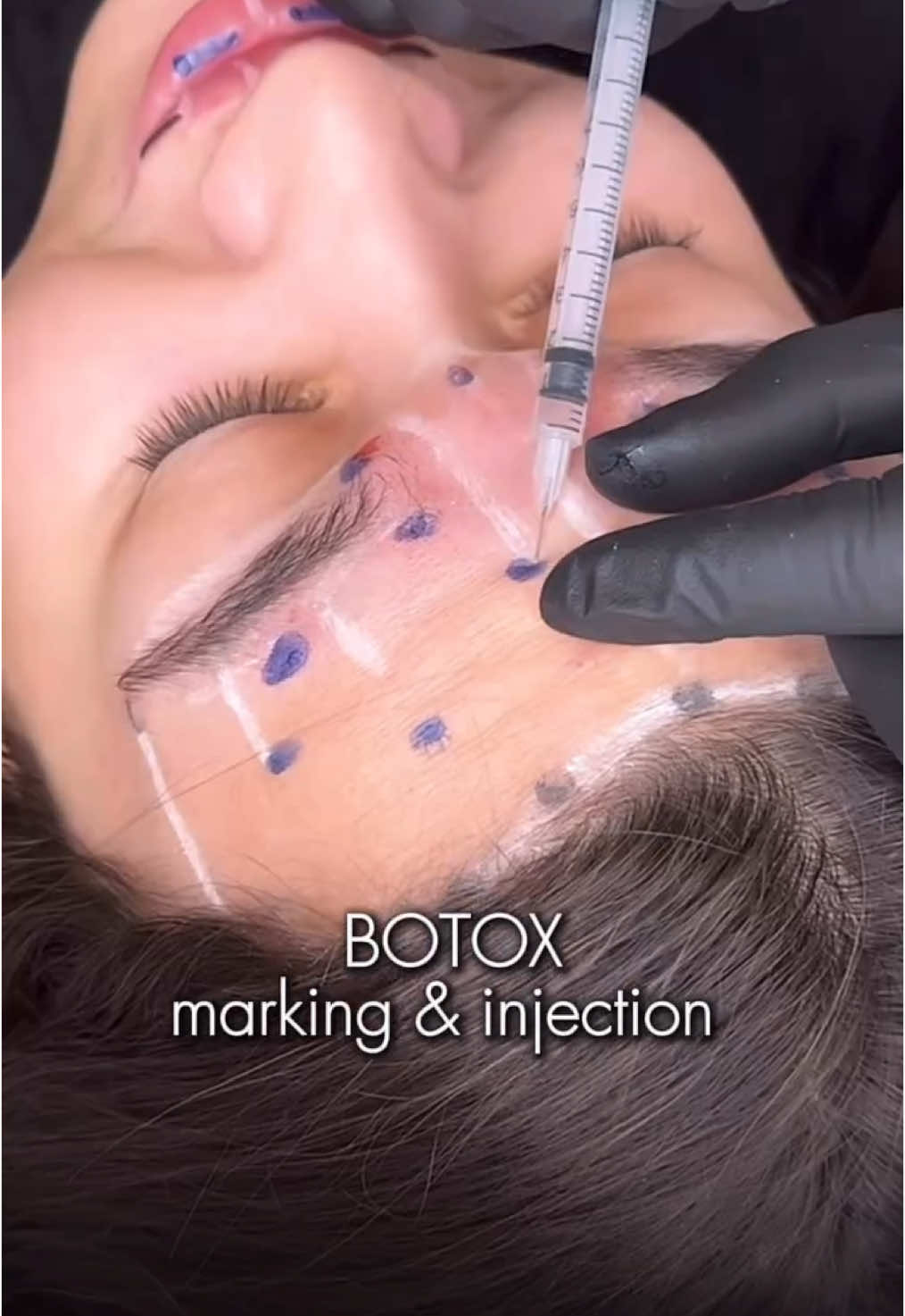 Botox Lift 💉 Result at the end The Botox lift is a technique that helps achieve a unique tissue lift inst: lfk.academy  New video lessons available 💥 By injection specific muscle groups in combination, we deliver outstanding results 🌟 Book your appointment now to experience the transformative effects! 👉 Sign up now: www.LFK-academy.com #recommendations #cosmetology #skincare  #fyp #fashion #estetik #lipfiller #jawline #fullface #botox #lifting #beauty#увеличениегуб #увеличениегубмосква #fullface #fullfaceмосква #fullfaceuk #lipfillersessex #lipaugumentation #коррекцияскул #lipfilleruk #коррекцияугловмосква #коррекцияскулмосква #лицоподключ #lipsaugmentationlondon #cheeksaugmentationlondon #russianlipstechnique #russianlips #russianlipstraining #lipsforkiss