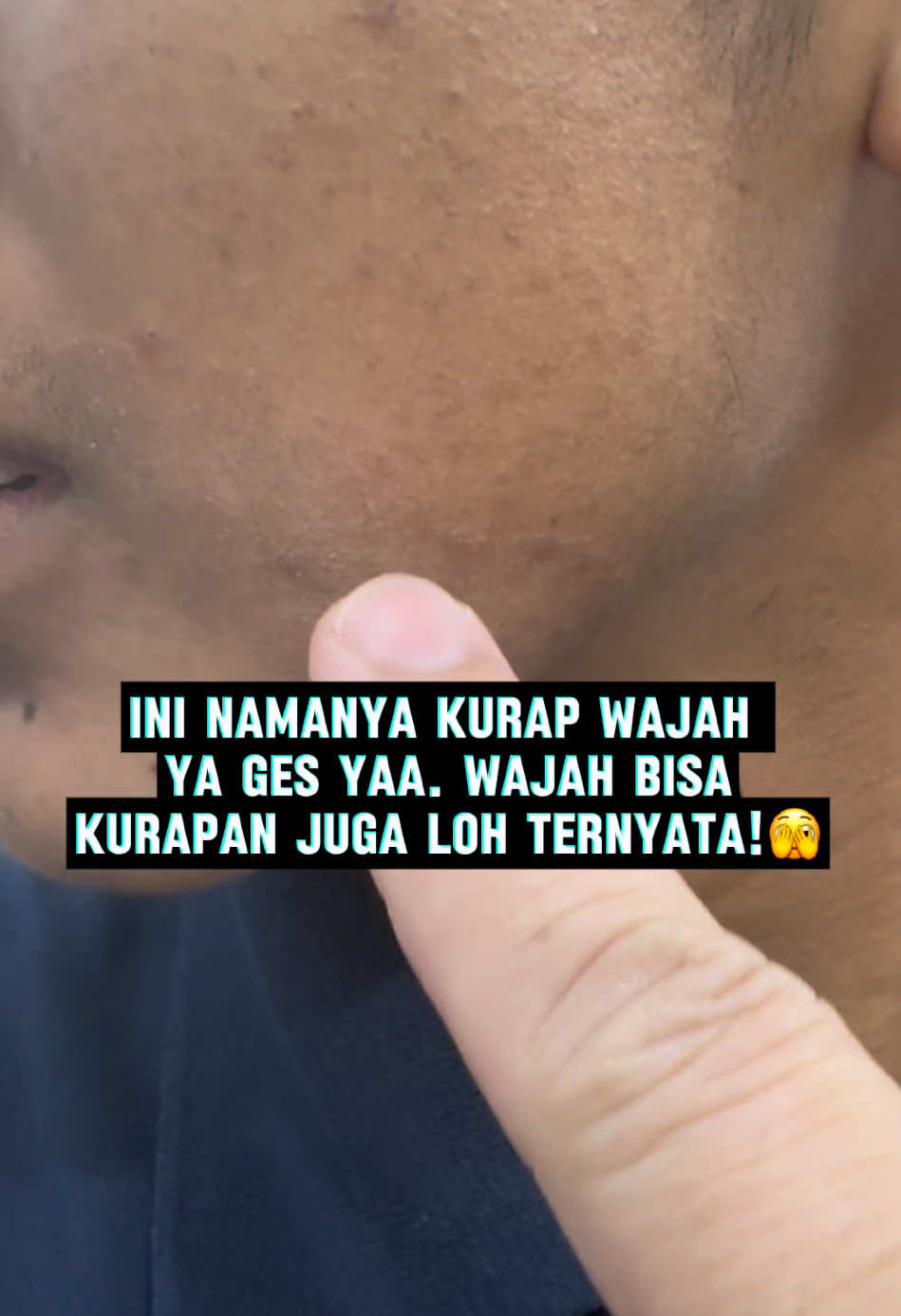 #minyakgeronggang #gatal #gatalgatal #gatalalergi #gatalgigitanserangga #infeksi #penyakitkulit #obatherbal #panu #kadas #obat #kurap #eksim #luka #kutuair #jerawat #dermatitis #biduran #psoriasis #jamuran #arbaplus #obatgatal #rekomendasidokter #fyp #viral #foryou #populer #beranda #trending 