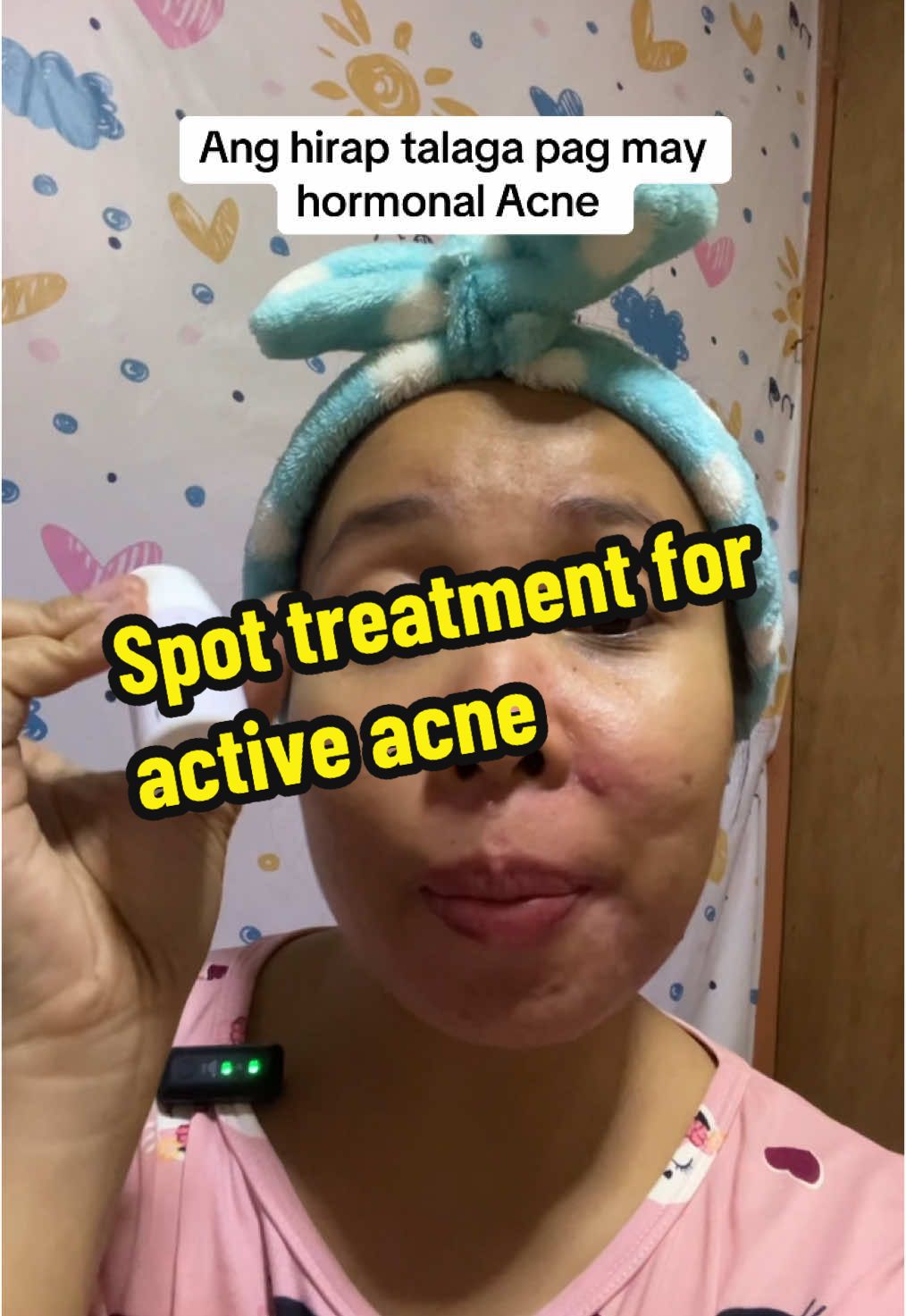 Ang hirap tlaga pag may hormonal acne, paulit ulit na sumulpot. Buti na labg napaka effective magpatuyo ng pimples ang “spotlite acne concentrate ng dmd skin sciences.   #spottreatment #spotliteacnetreatment #acnespotlitedmd #hormonalacne #acnetreatment @Dr. Mike D #didas #didasfinds 